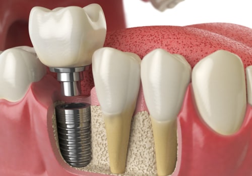 The Road To A New Smile: Periodontics Leading To Dental Implants In Cedar Park, TX