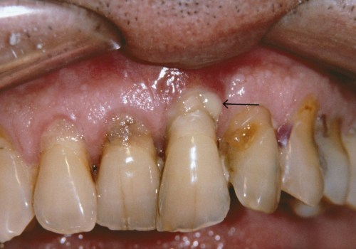 What are the Symptoms of Periodontitis and How Can You Prevent It?