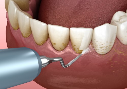 Treating Periodontal Disease: A Comprehensive Guide