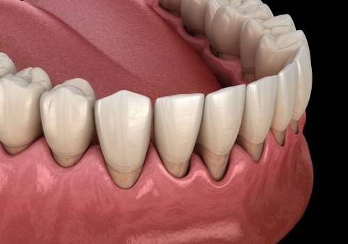 What is a Gum Graft? A Comprehensive Guide