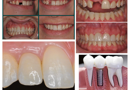 Smile Confidently With Dentures In Austin: How Periodontics Makes A Difference
