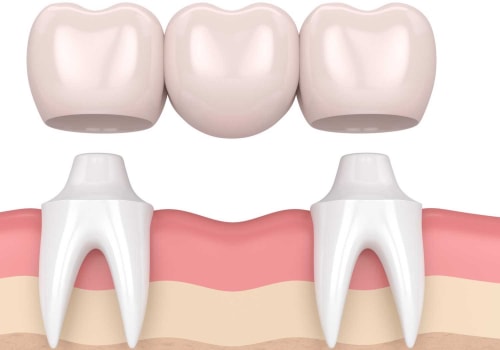 What is a Dental Bridge and How Can it Help You?