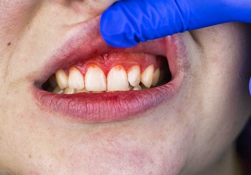 What are the Symptoms of Periodontal Disease?
