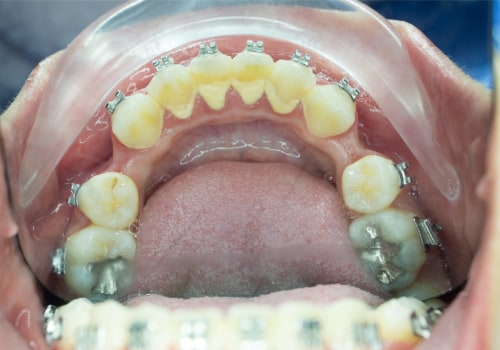 Can I Get Braces If I Have Periodontal Disease?