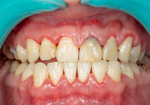 What Does Stage 1 Periodontal Disease Look Like?
