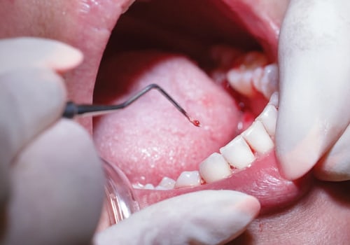 Periodontics: Common Treatments and Procedures