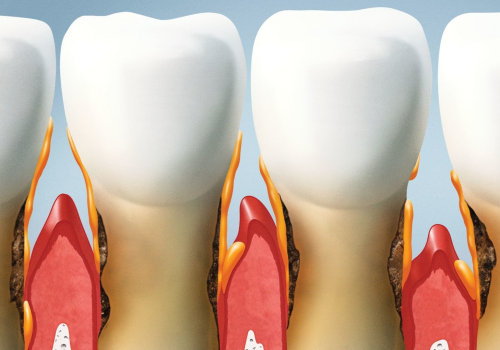 How to Fix Gum Pockets: A Guide for Dentists
