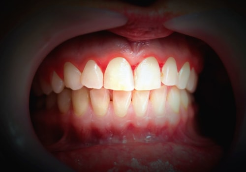 The Impact of Stress on Periodontal Health