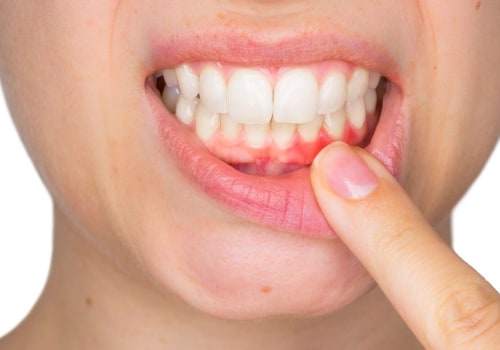 What is Periodontitis and How Can it be Treated?
