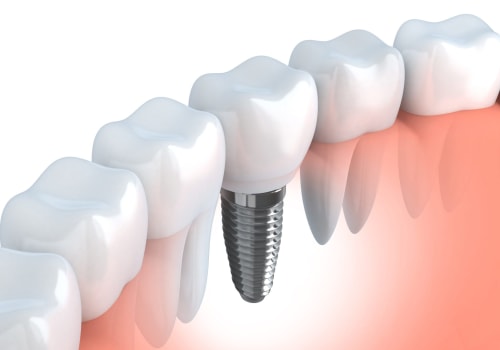 Can Dental Implants And Periodontics Help Improve Overall Oral Health During Full Teeth Replacement In Bexley?