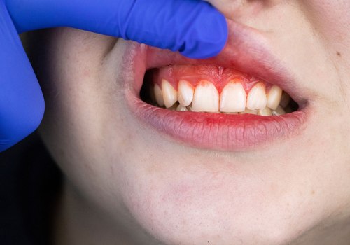 Types of Periodontal Diseases: What You Need to Know