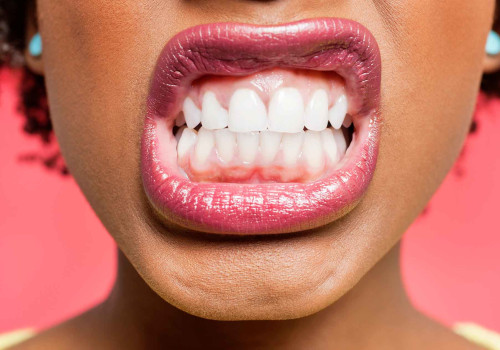 Gingivitis: What You Need to Know