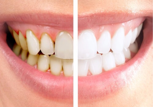 Treating Periodontal Disease: Medications That Can Help