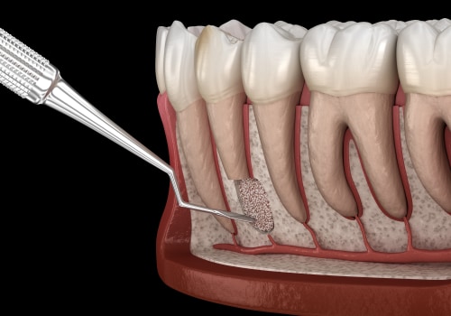 What is the Most Common Periodontal Surgery?